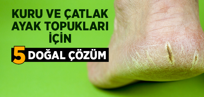 Kuru ve Çatlak Ayak Topukları İçin 5 Doğal Çözüm