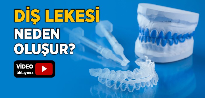 Diş Lekesi Neden Oluşur?