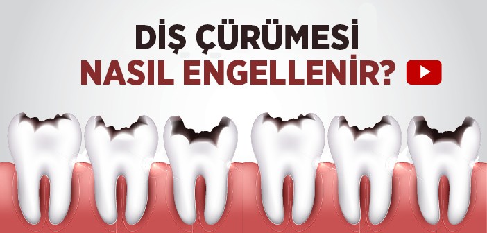 Diş Çürüğü Nasıl Engellenir?