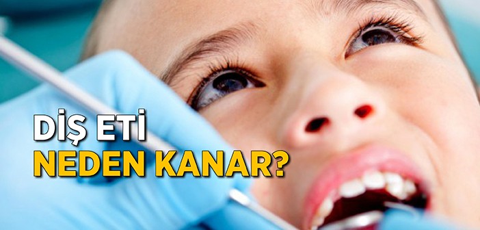 Diş Eti Neden Kanar?