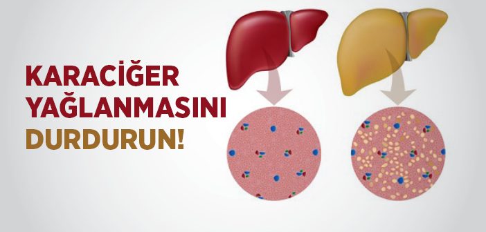 Karaciğer Yağlanmasını Durdurun!