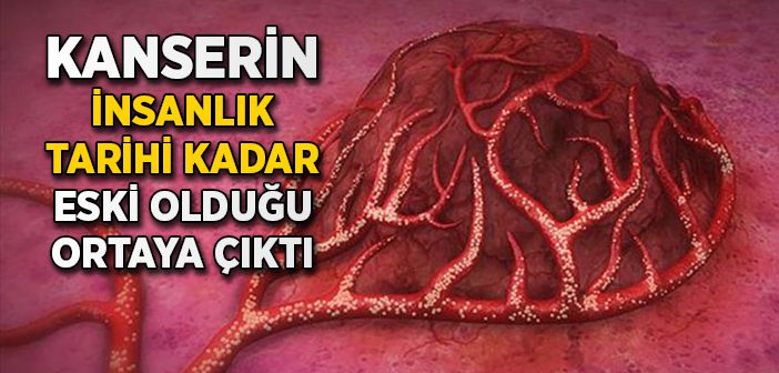 Kanserin İnsanlık Tarihi Kadar Eski Olduğu Ortaya Çıktı