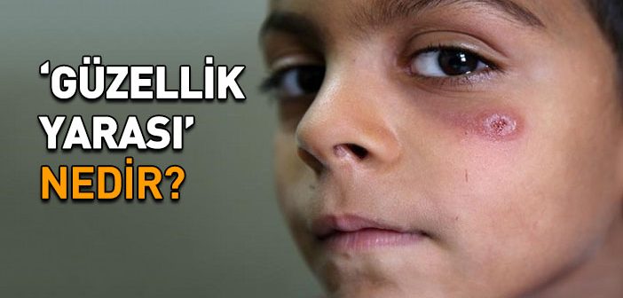 ‘güzellik Yarası’ Nedir?