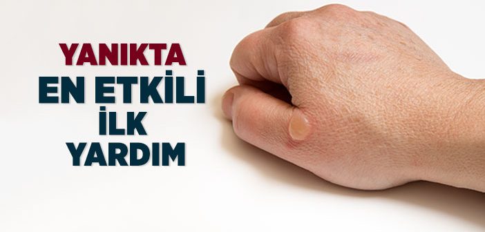 Yanıkta En Etkili İlk Yardım