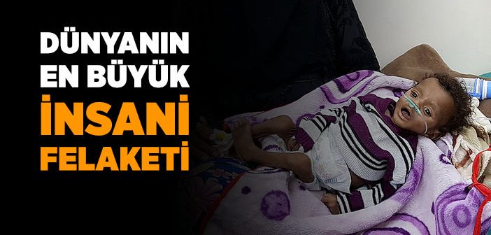 Yemen’de Kıtlık En Çok Çocukları Vuruyor