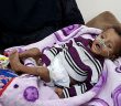 Yemen’de Kıtlık En Çok Çocukları Vuruyor