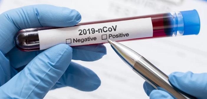 Koronavirüs (Covid-19) Test Sonucu Nasıl Öğrenilir?