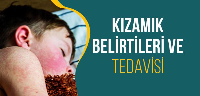 Kızamık Nedenleri, Belirtileri ve Tedavisi